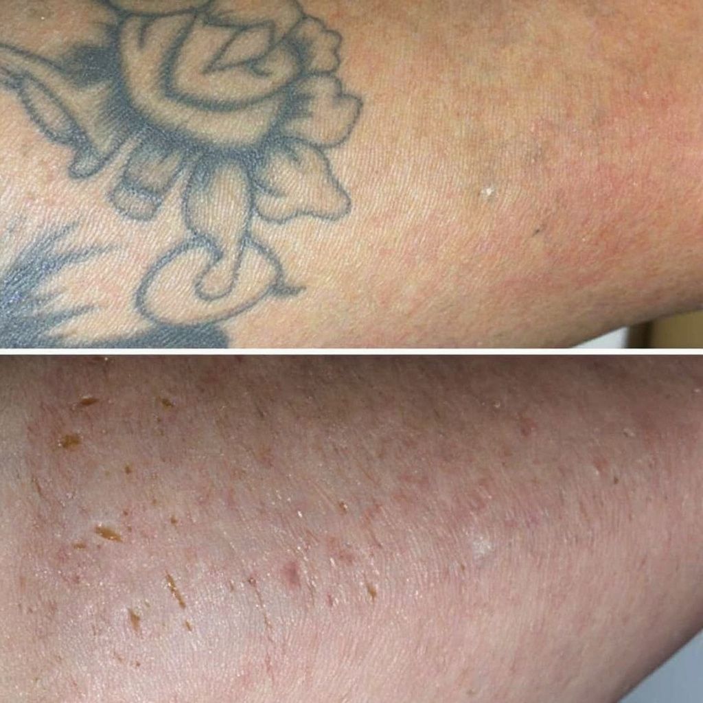 Tattoo Removal Cost Calculator